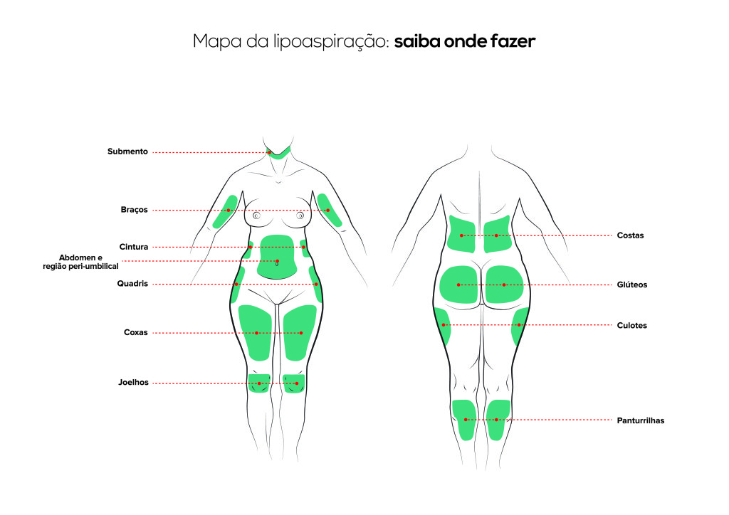 Mapa_da_lipoaspiração