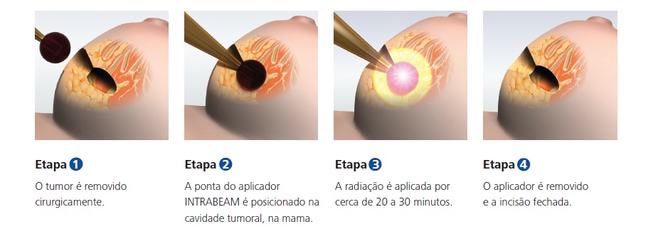 Intrabeam_1