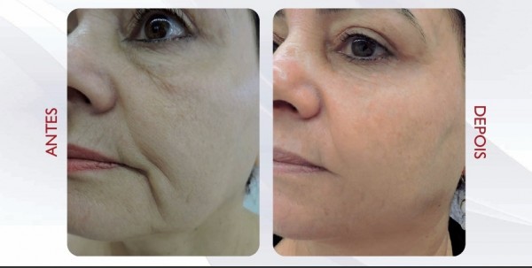 rejuvenescimento-e1439223712977