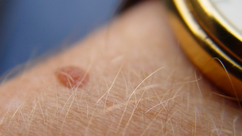 Red Moles On Skin and Treatment