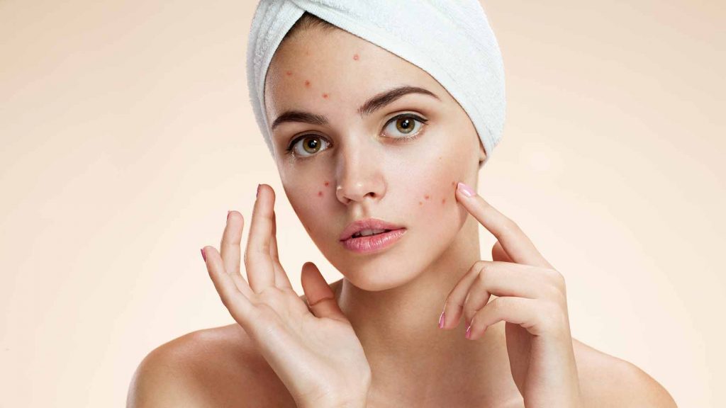 acne-cover